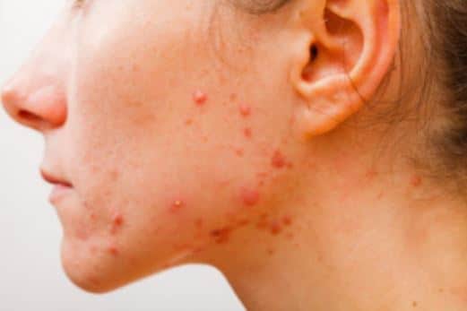 How To Get Rid Of Cystic Acne On Neck | Apps Directories