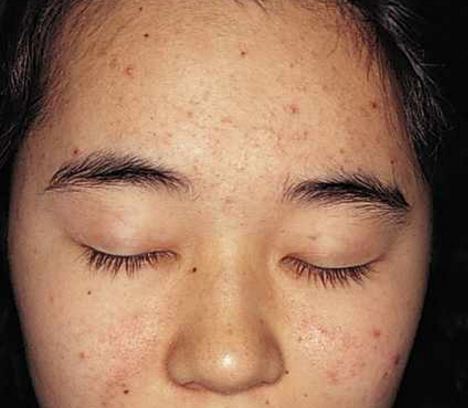How To Get Rid Of Black Spots From Pimples Also How To Get Rid 