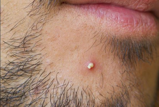 How to Get Rid of Pimple Marks Fast How to Heal Pimple Scabs Naturally 