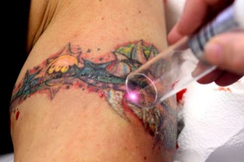 Laser tattoo removal can end up with an infection if the aftercare is ...