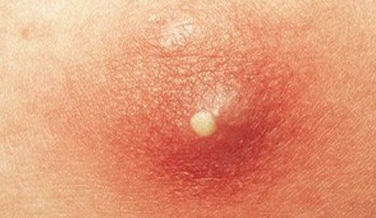 first-rate foundation for zits scars