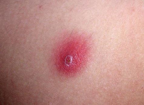 red blotches on chest - MedHelp