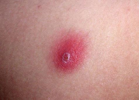 images of ringworm on arm #11