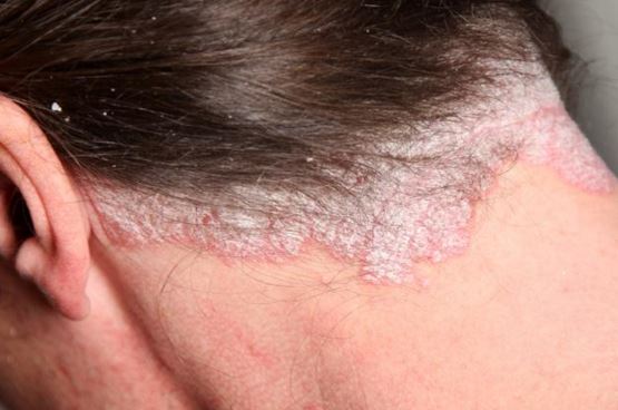 Common Rashes: Types, Symptoms, Treatments, & More - WebMD