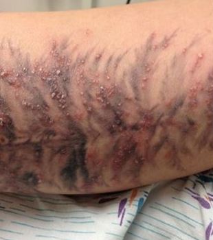 ... Symptoms, Signs of Back Tattoo Infection, Healing after Laser, Video