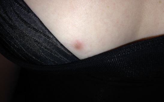 itchy rash on chest, stomach, breast has been spreading ...