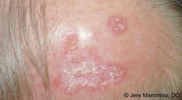 Discoid Lupus Erythematosus - American Osteopathic College ...