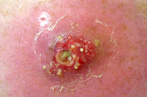 Image Gallery infected acne