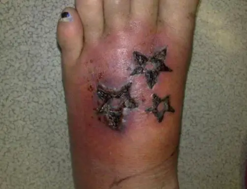Infected Tattoo, Images, How to Treat, Care, Staph ...