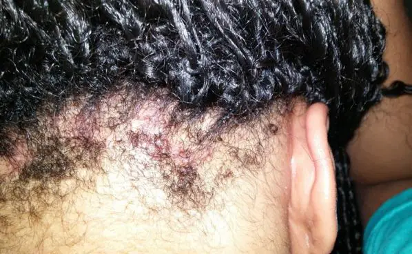 Tight braids, extensions and perm will cause sores on your head