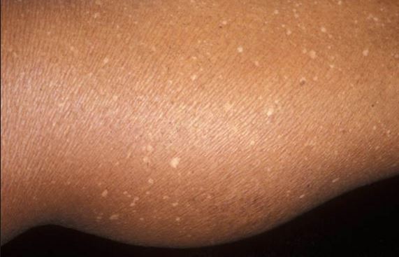 What are common causes for spots on the skin?