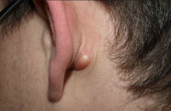 sinus behind ear