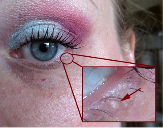 What are the symptoms of eyelid cysts?