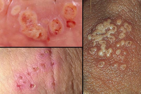 What Does A Herpes Rash On The Face Look Like - The Body