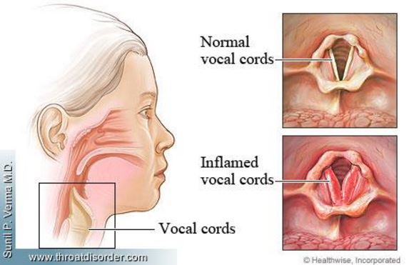 Dry Cough Throat 116