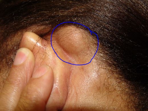 Lump Behind Ear | Med-Health.net