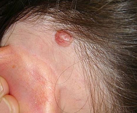 Lump under scalp - Family Health - MedHelp