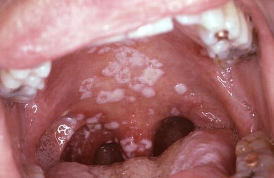 Throat Irritation Allergies 56