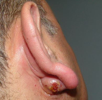 Rash Behind Ear - Causes, Pictures, Symptoms, Treatment