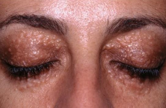 Rash around the Eyes: Causes and Natural Treatments
