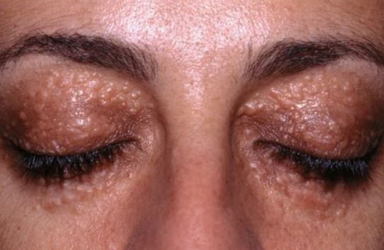 What causes rashes to form around one eye but not the ...