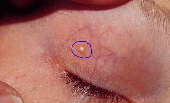 hard bump on scalp under skin