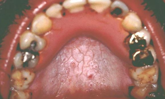 P On Roof Of Mouth Hard Painful Lump Palate Small White P On Roof Of Mouth Due To Smoking