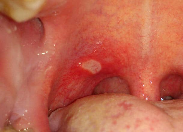 Red Spots On Roof Of Mouth And Throat 58