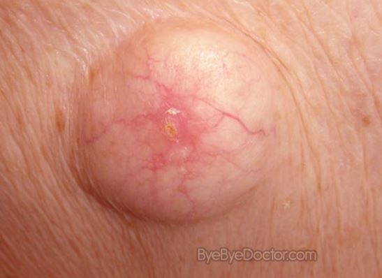 Red to dark dots on the scrotum - Dermatology - MedHelp