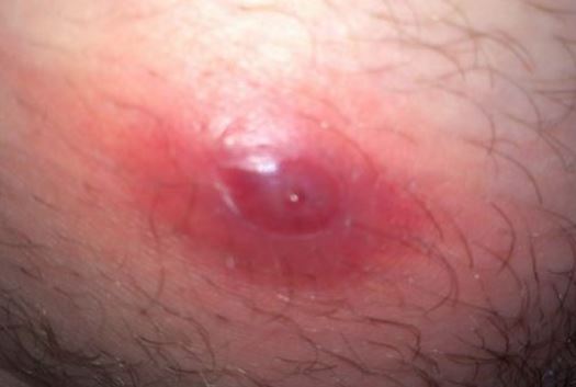 Cysts Of The Penis 23