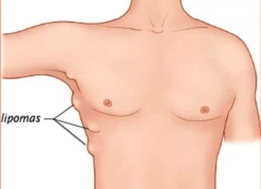 Lump Near Ribs In Woman 84