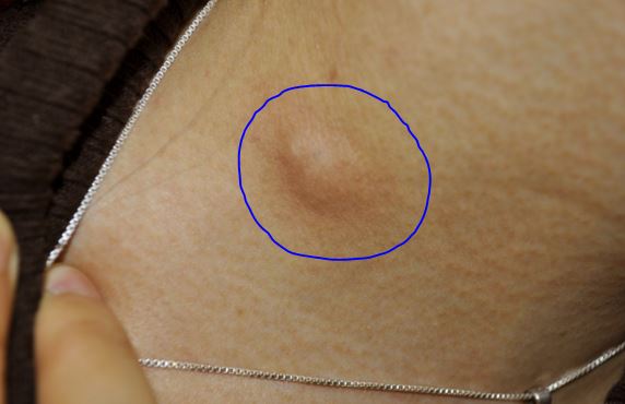 Doctor insights on: I Have Red Bumps Under My Armpits
