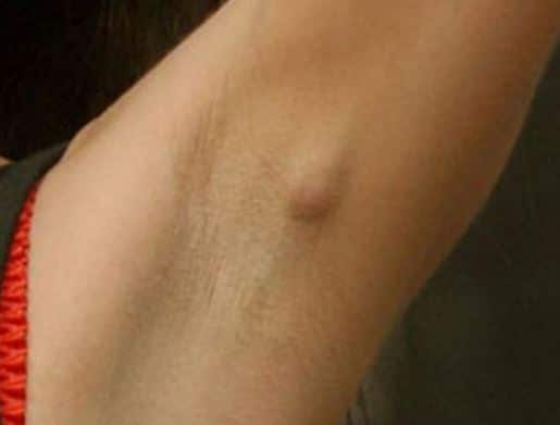 Itchy Armpits: Causes and Treatments | MD-Health.com