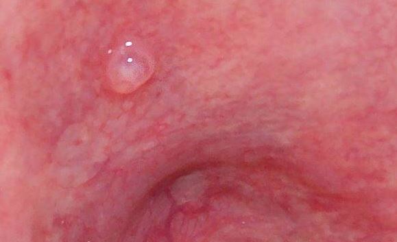 Small Lump On Roof Of Mouth 40