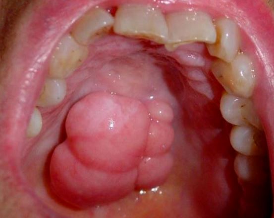 Why is the roof of my mouth swollen?