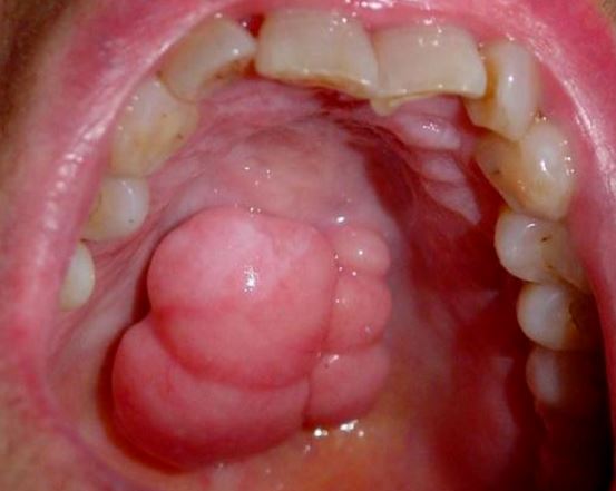 What could a lump or bump on the roof of your mouth be?