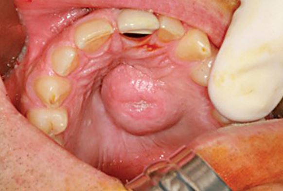 Swelling In Roof Of Mouth 32