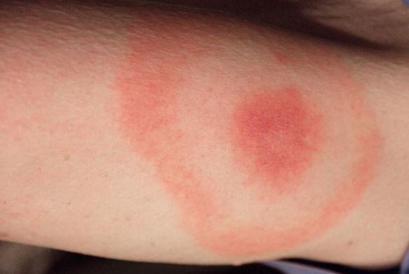 Are You Allergic To Insect Stings? Types Of Reactions ...