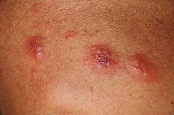 Flea Bites on Humans — Pictures, Treatment & Prevention