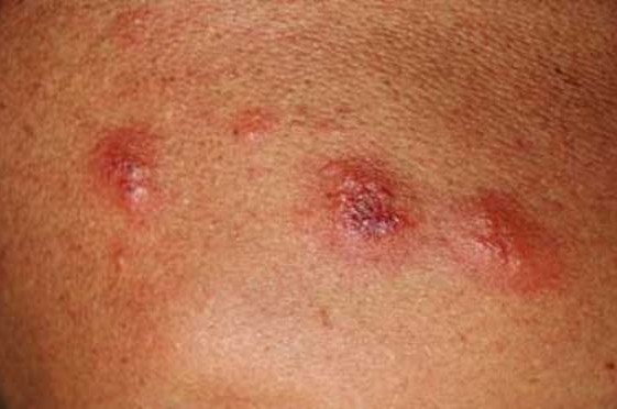 Picture of Flea Bites - WebMD