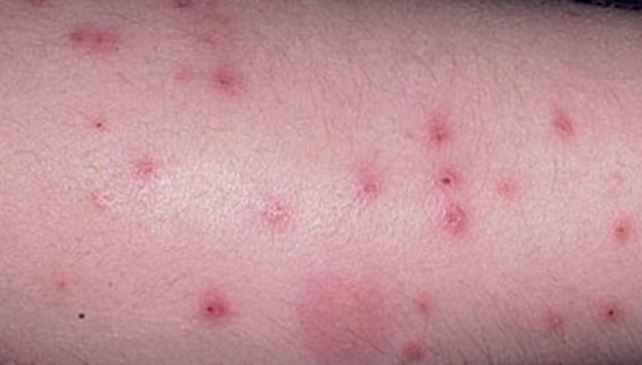 Folliculitis Treatment & Management: Medical Care ...