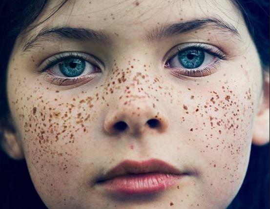freckles face rid fast skin lips permanently sun cheeks naturally freckle freckled eyes fade blemishes freckels born spots disorders problems