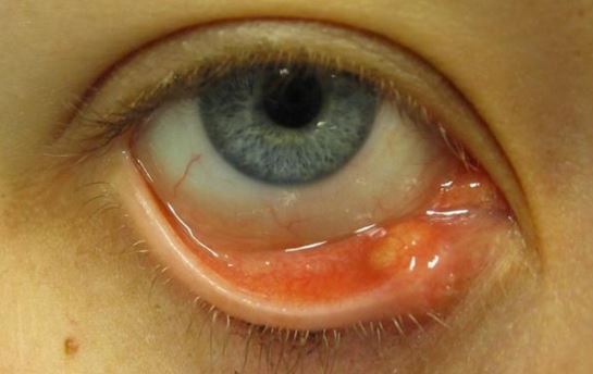how to cure a stye in the eye how to cure a stye in the eye