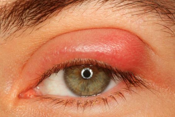 Pimple On Eyelid Under Inside On Rim Small White Lump Upper Eyelid pimple-on-eyelid-under-inside-on-rim-small-white-lump-upper-eyelid