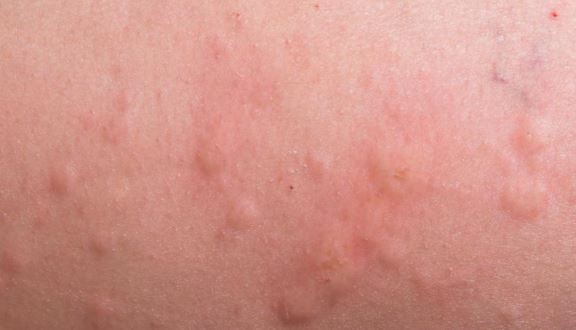 Picture of Flea Bites - WebMD