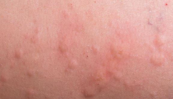 Picture of Flea Bites - WebMD