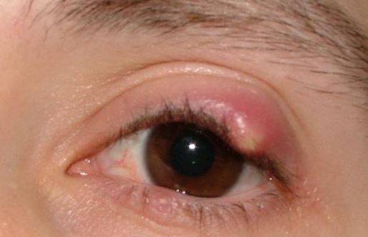 Pimple on Eyelid, Under, Inside, on Rim, Small White Lump ...