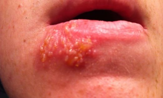 Do's and Don'ts for fighting cold sores, how to get rid of ...