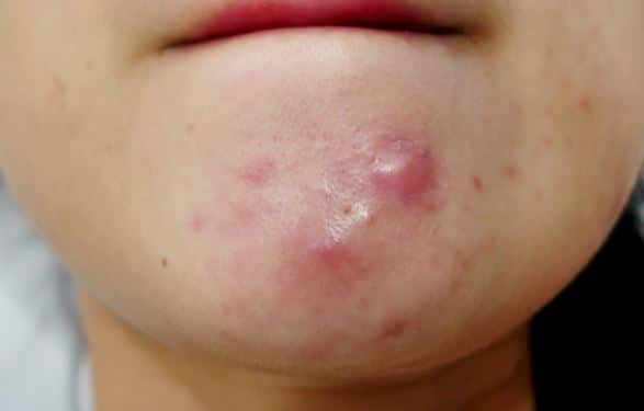 herpes scars pictures