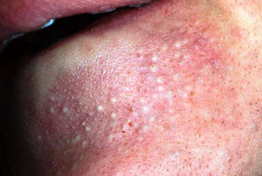 White bumps on chin can also be keratosis pilaris